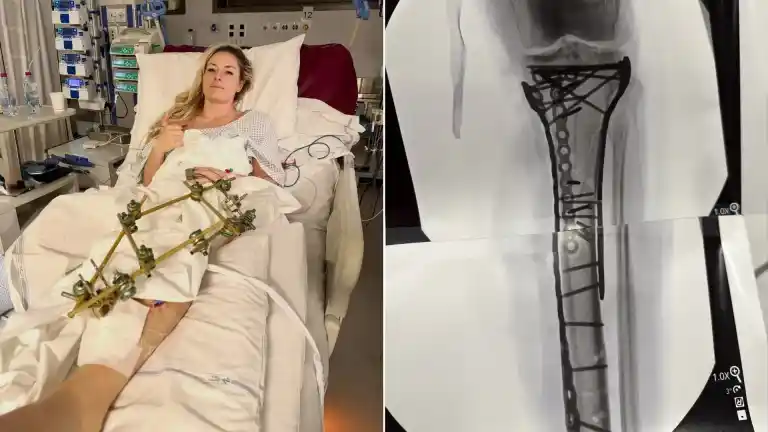 Imagen 1 de Lindsey Vonn pudo necesitar una amputación después de su caída: "El doctor me salvó la pierna, todo estaba en pedazos".